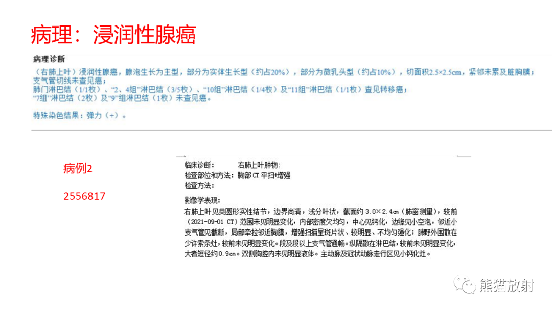 【病例】肺原位腺癌 VS 浸润性腺癌-9