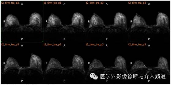 【病例】乳腺癌1例MR影像表现