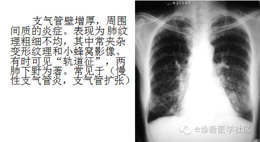 3分钟读懂胸片上肺纹理的改变