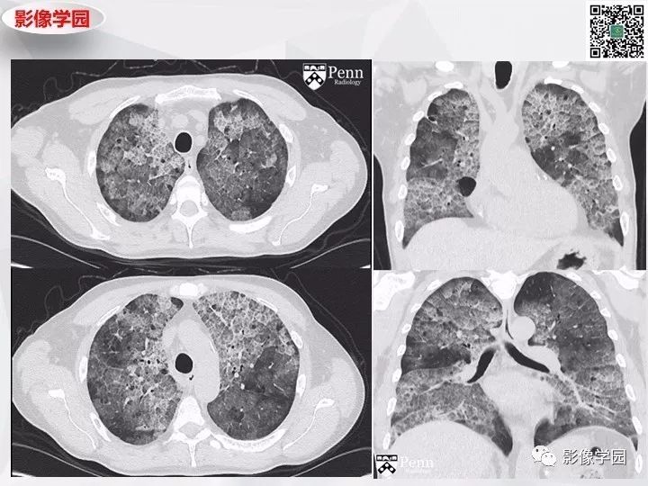 【双语病例】肺泡蛋白沉积症PAP一例CT
