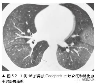 HRCT:磨玻璃影的意义
