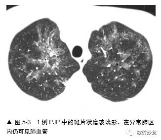 HRCT:磨玻璃影的意义