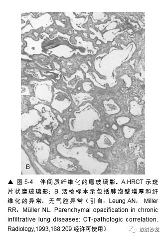 HRCT:磨玻璃影的意义