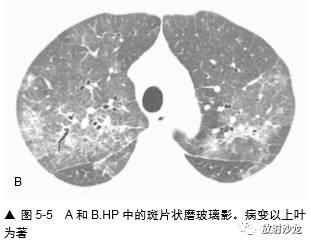 HRCT:磨玻璃影的意义