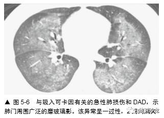 HRCT:磨玻璃影的意义