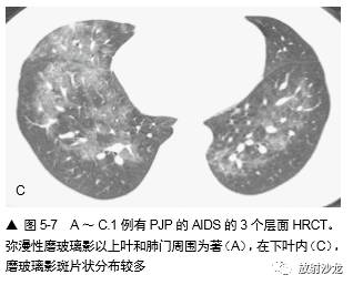 HRCT:磨玻璃影的意义