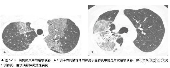 HRCT:磨玻璃影的意义