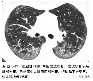 HRCT:磨玻璃影的意义