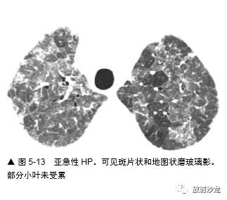 HRCT:磨玻璃影的意义