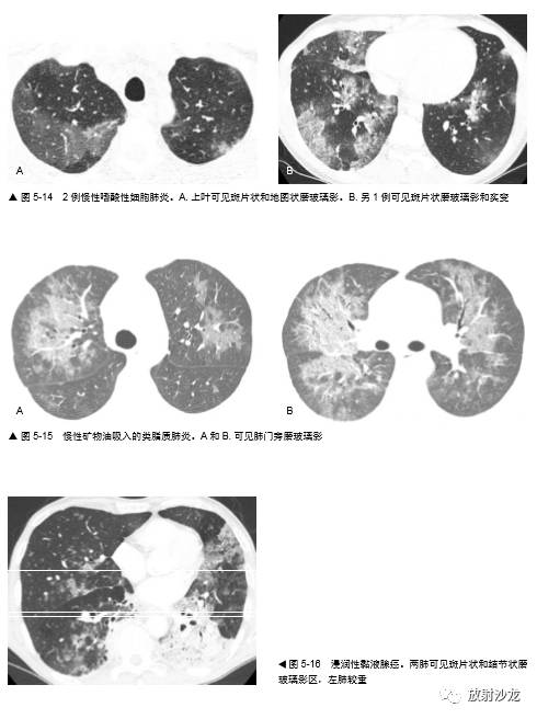 HRCT:磨玻璃影的意义
