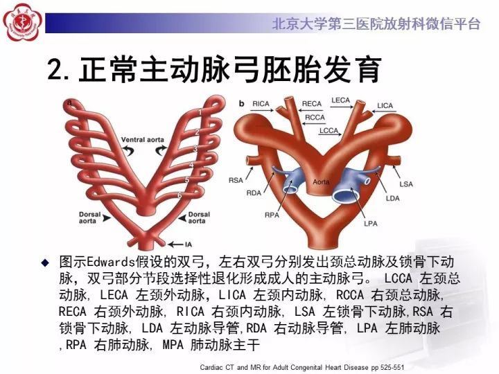 【病例】双主动脉弓畸形1例CT