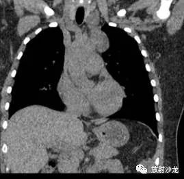 【病例】前纵隔神经鞘瘤一例CT影像表现