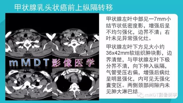 【PPT】纵隔肿瘤影像诊断（全）