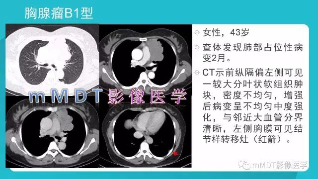 【PPT】纵隔肿瘤影像诊断（全）