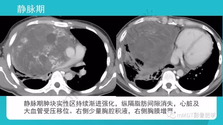 【PPT】纵隔肿瘤影像诊断（全）