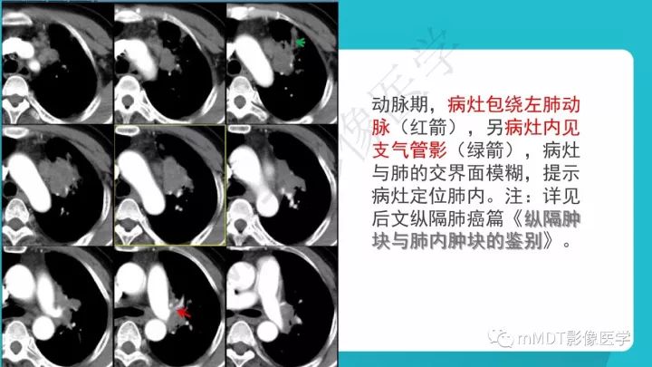 【PPT】纵隔肿瘤影像诊断（全）