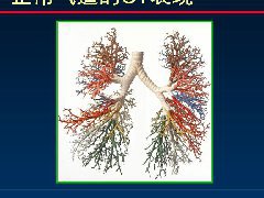 正确判读支气管异常的CT征象