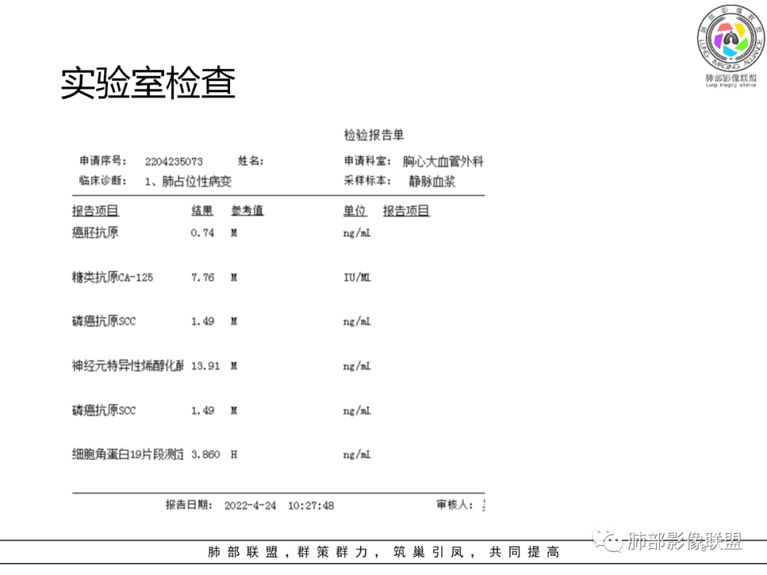 【病例】硬化性肺泡细胞瘤PSP一例CT-3