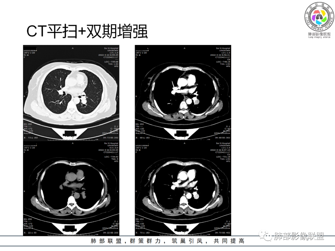 【病例】硬化性肺泡细胞瘤PSP一例CT-9