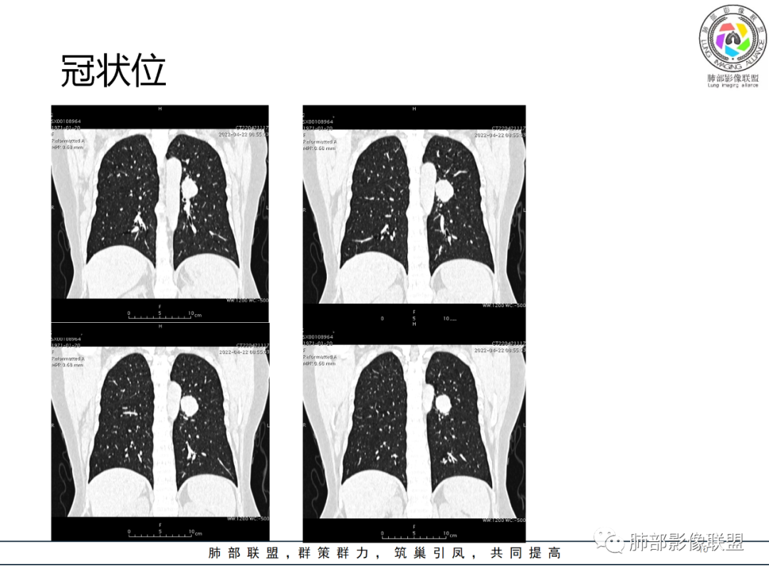 【病例】硬化性肺泡细胞瘤PSP一例CT-10