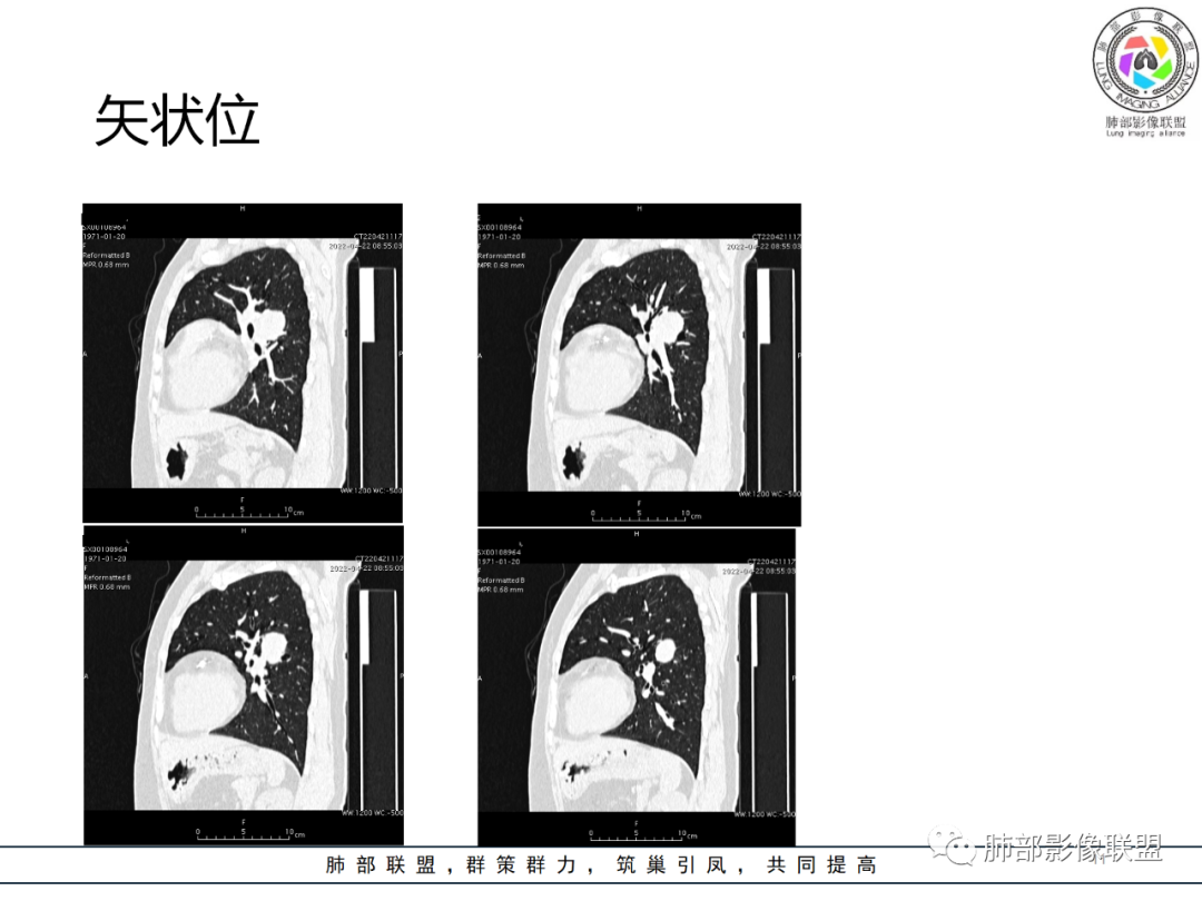 【病例】硬化性肺泡细胞瘤PSP一例CT-11
