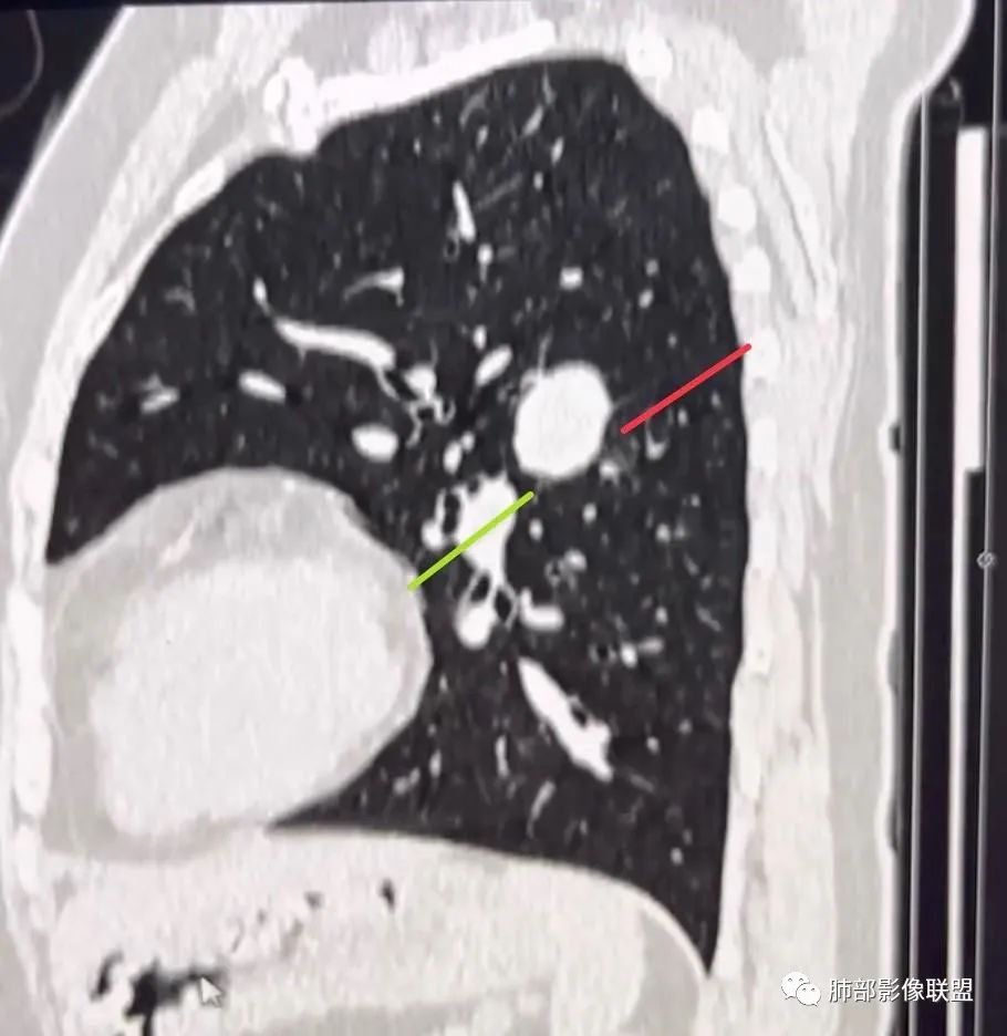 【病例】硬化性肺泡细胞瘤PSP一例CT-14
