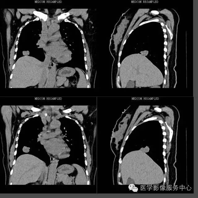 【病例】右下肺乳头状腺癌1例CT影像表现