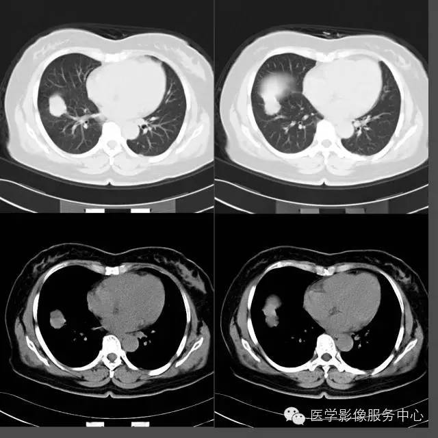 【病例】右下肺乳头状腺癌1例CT影像表现