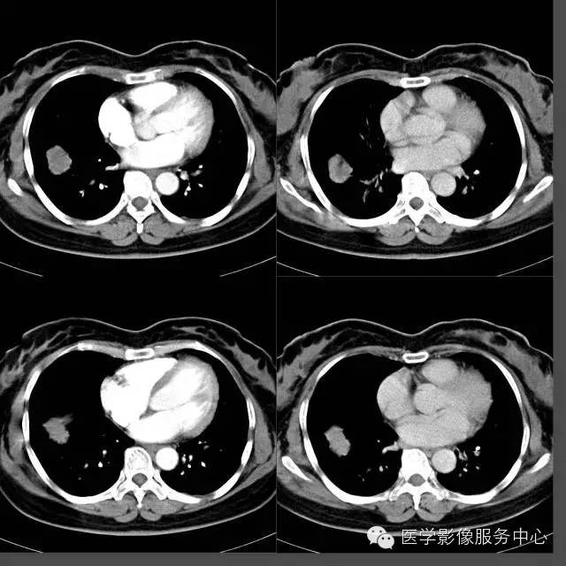 【病例】右下肺乳头状腺癌1例CT影像表现