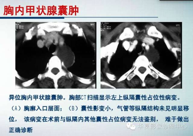 【PPT】纵隔囊肿性病变的影像学诊断
