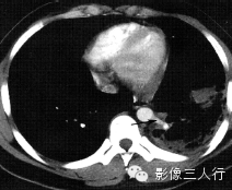 肺囊性病变的鉴别诊断