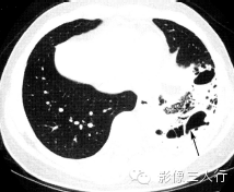 肺囊性病变的鉴别诊断