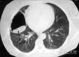 肺囊性病变的鉴别诊断