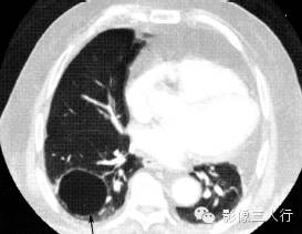 肺囊性病变的鉴别诊断