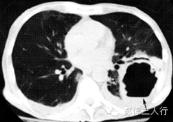 肺囊性病变的鉴别诊断