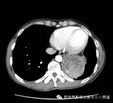 【病例】肺部纱布瘤1例CT影像表现