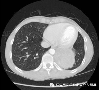 【病例】肺部纱布瘤1例CT影像表现