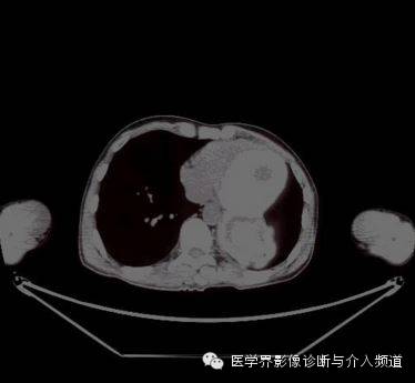 【病例】肺部纱布瘤1例CT影像表现