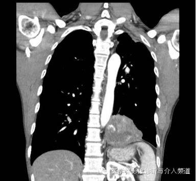 【病例】肺部纱布瘤1例CT影像表现