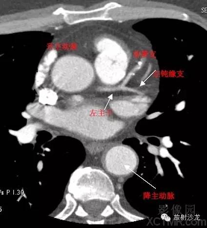 心脏冠状动脉CT解剖中文详细标注