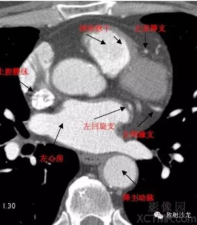 心脏冠状动脉CT解剖中文详细标注