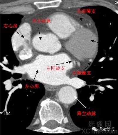 心脏冠状动脉CT解剖中文详细标注