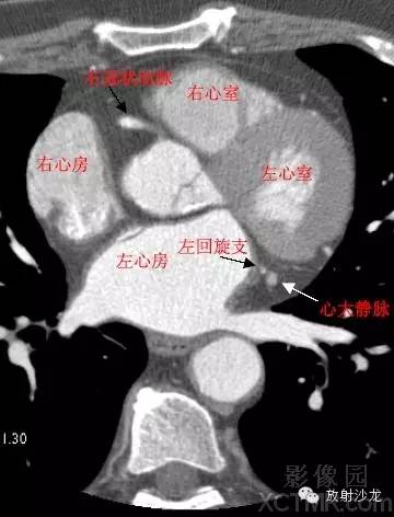 心脏冠状动脉CT解剖中文详细标注