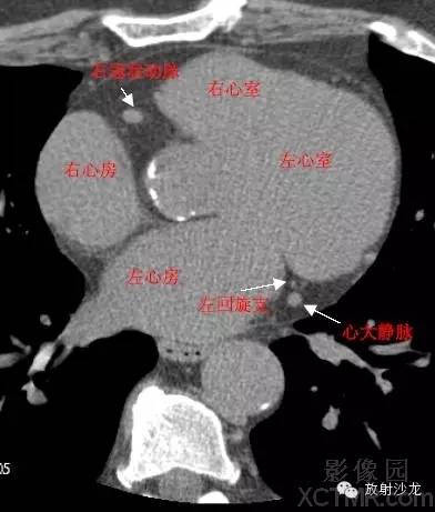 心脏冠状动脉CT解剖中文详细标注