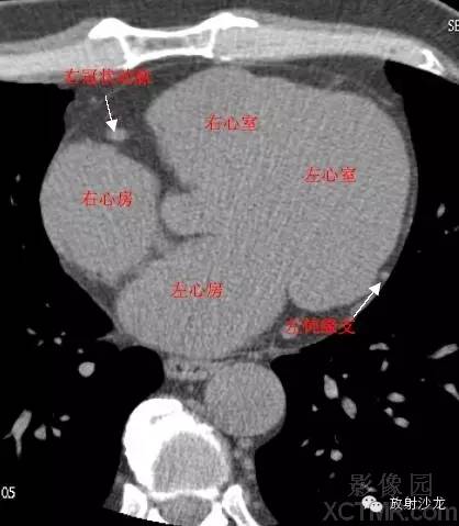 心脏冠状动脉CT解剖中文详细标注