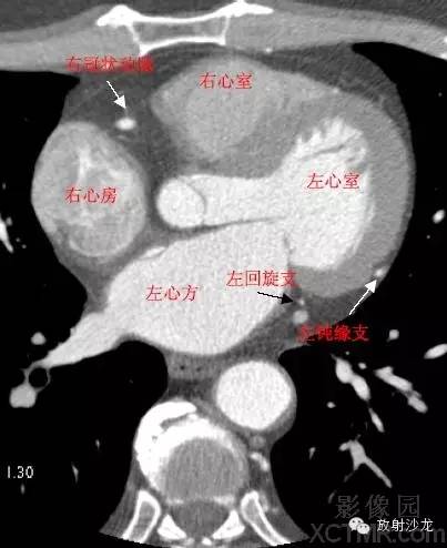 心脏冠状动脉CT解剖中文详细标注