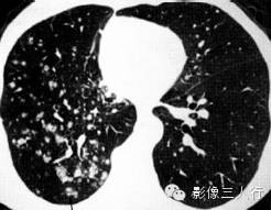 肺内粟粒状小结节的鉴别诊断
