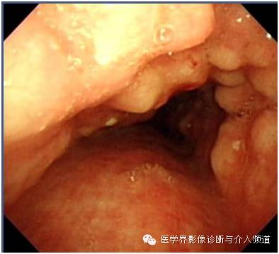 【病例】骨化性气管支气管病1例CT影像表现