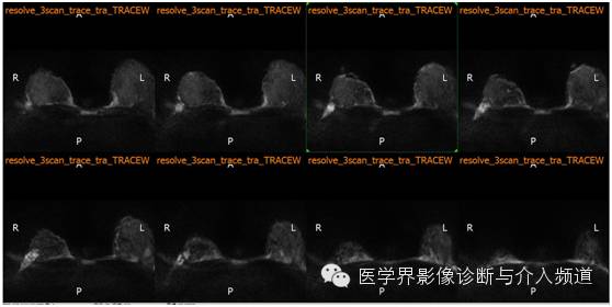 【病例】乳腺癌1例MR影像表现