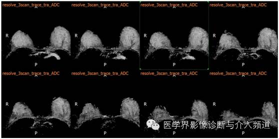 【病例】乳腺癌1例MR影像表现